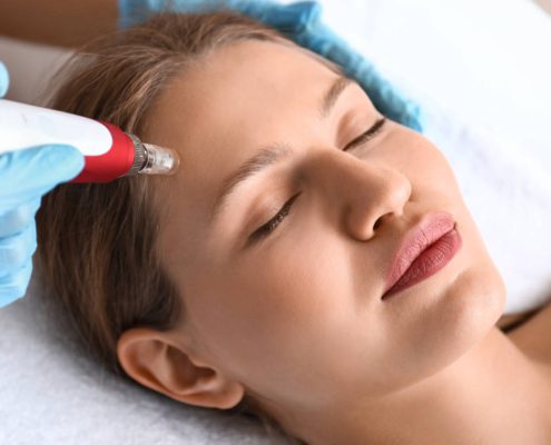 Kobieta w salonie kosmetycznym ma zabieg mezoterapii mikroigłowej na twarz, która jest sposobem na promienną skórę.